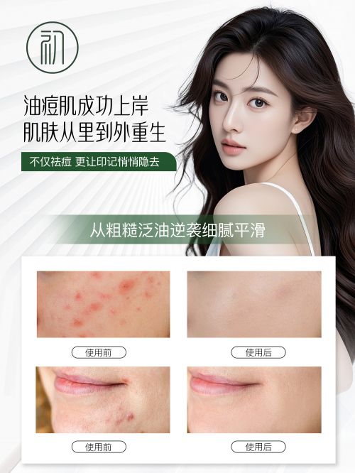 ！2025祛痘产品报告公认好用品品牌PG麻将胡了国家唯一认证的祛痘产品(图3)